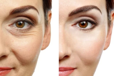 Botox Treatment in Purnia, Fillers in Purnia, Cost of Botox and Fillers in Purnia, Bihar