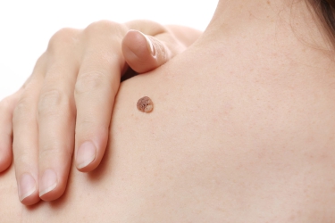 Laser Mole Removal, Wart Removal, Best Centre for Mole & Wart Removal in Purnia, Skyn and Laser Clinic, Dr Poonam Raut best Skin Specialist