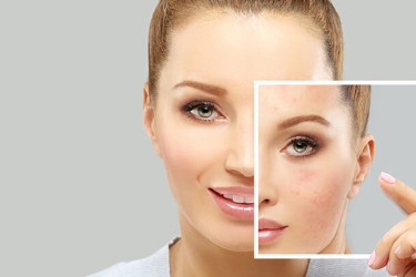 Laser Scar Removal in Purnia, Skyn & Laser Clinic, Dr Poonam Raut, Best Skin and Laser Specialist, Cost of Laser Scar Removal